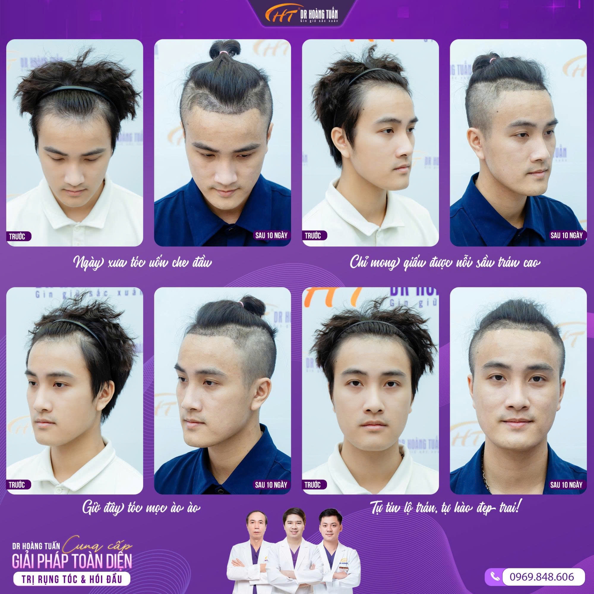 rụng tóc ở nam giới tuổi 20
